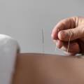 Therapeutic Dry Needling: 5 Things You Should Know